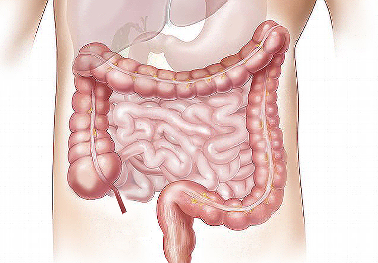 Colon Cancer