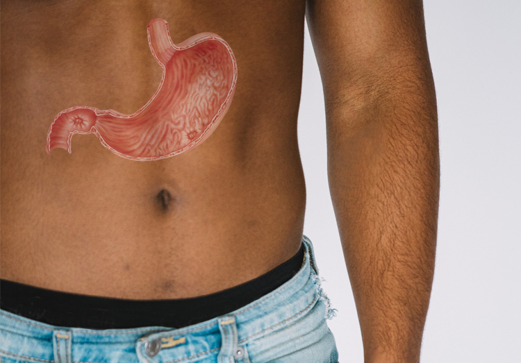 Peptic ulcers